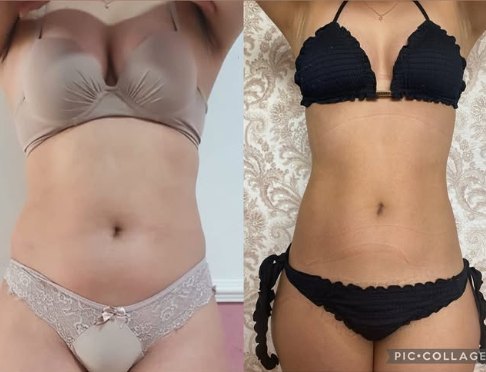Antes e depois de paciente, vista frontal, com redução de abdômen