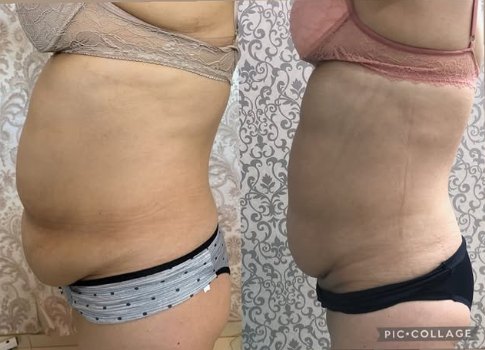 Antes e depois de paciente, vista lateral